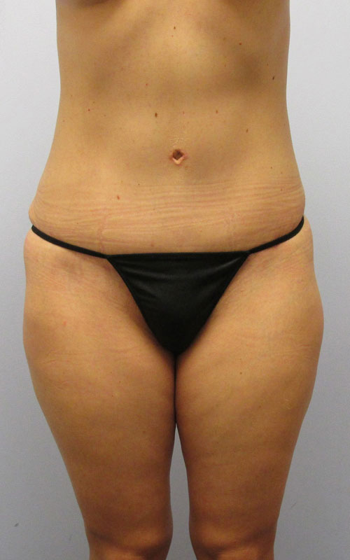 Tummy Tuck Before & After Image