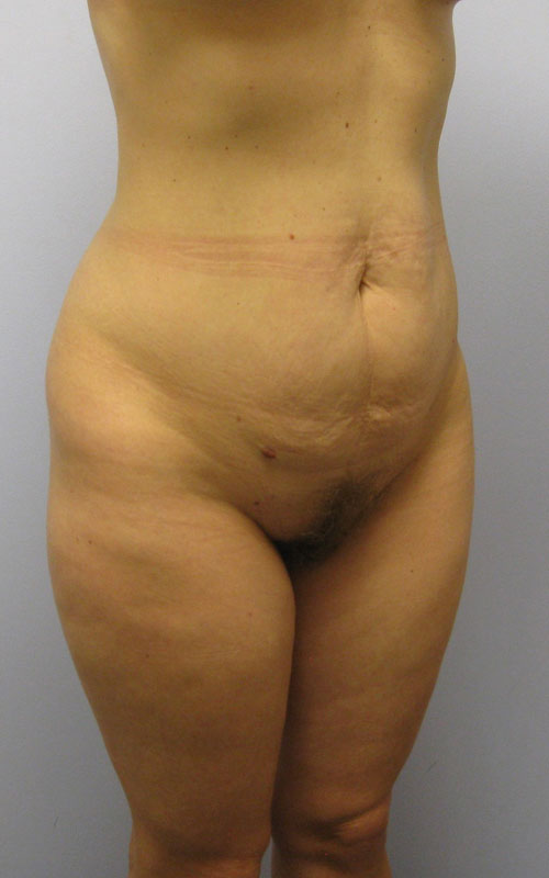 Tummy Tuck Before & After Image