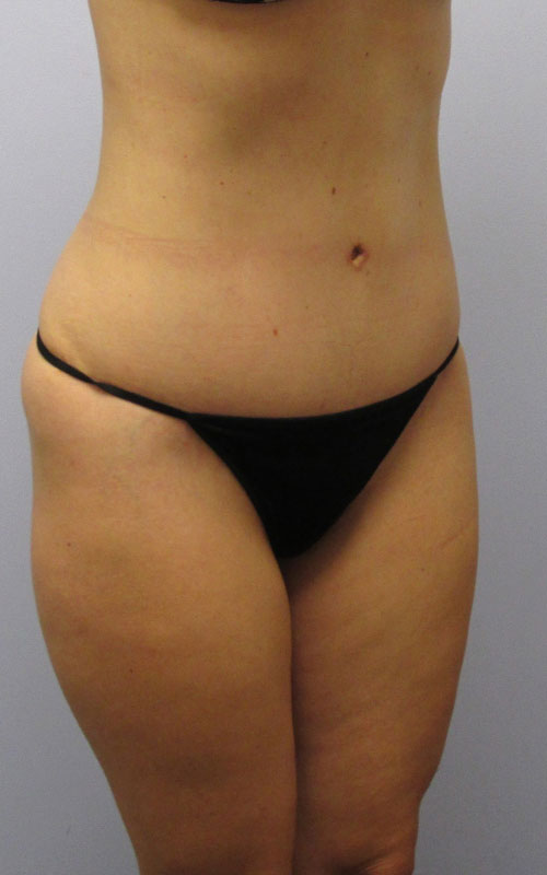 Tummy Tuck Before & After Image