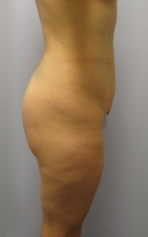 Tummy Tuck Before & After Image