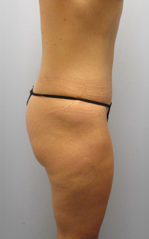 Tummy Tuck Before & After Image