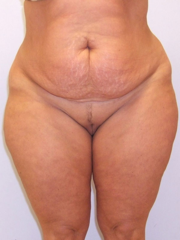 Tummy Tuck Before & After Image