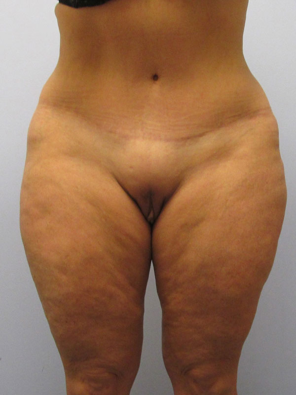 Tummy Tuck Before & After Image