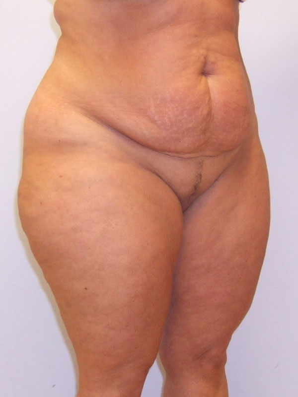 Tummy Tuck Before & After Image