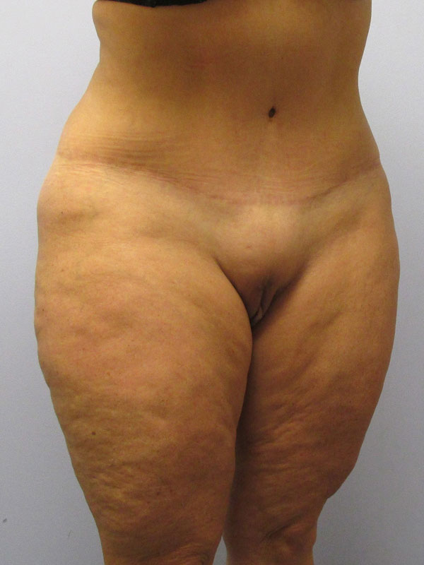 Tummy Tuck Before & After Image