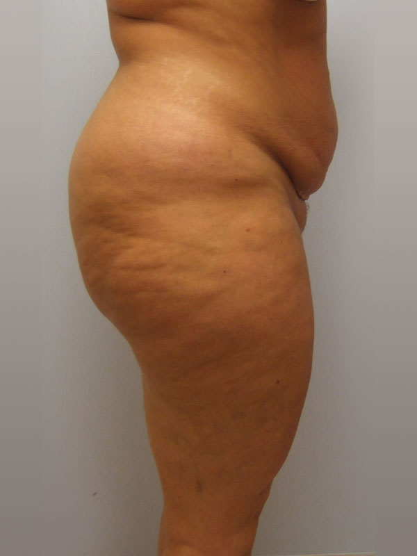 Tummy Tuck Before & After Image