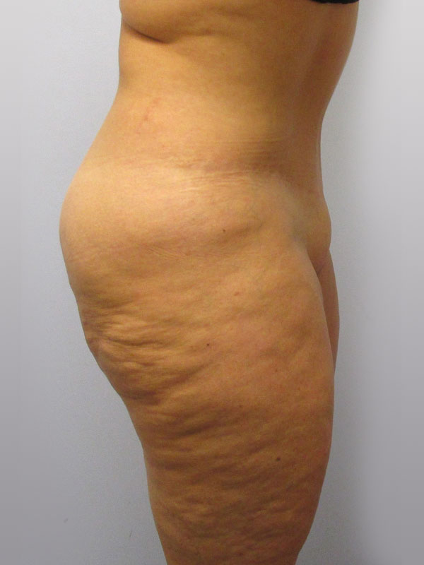 Tummy Tuck Before & After Image