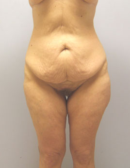 Body Lift Before & After Image