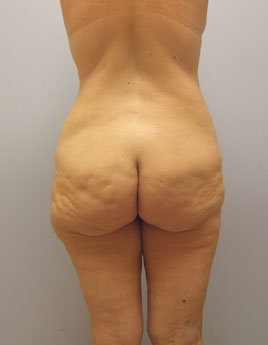 Body Lift Before & After Image