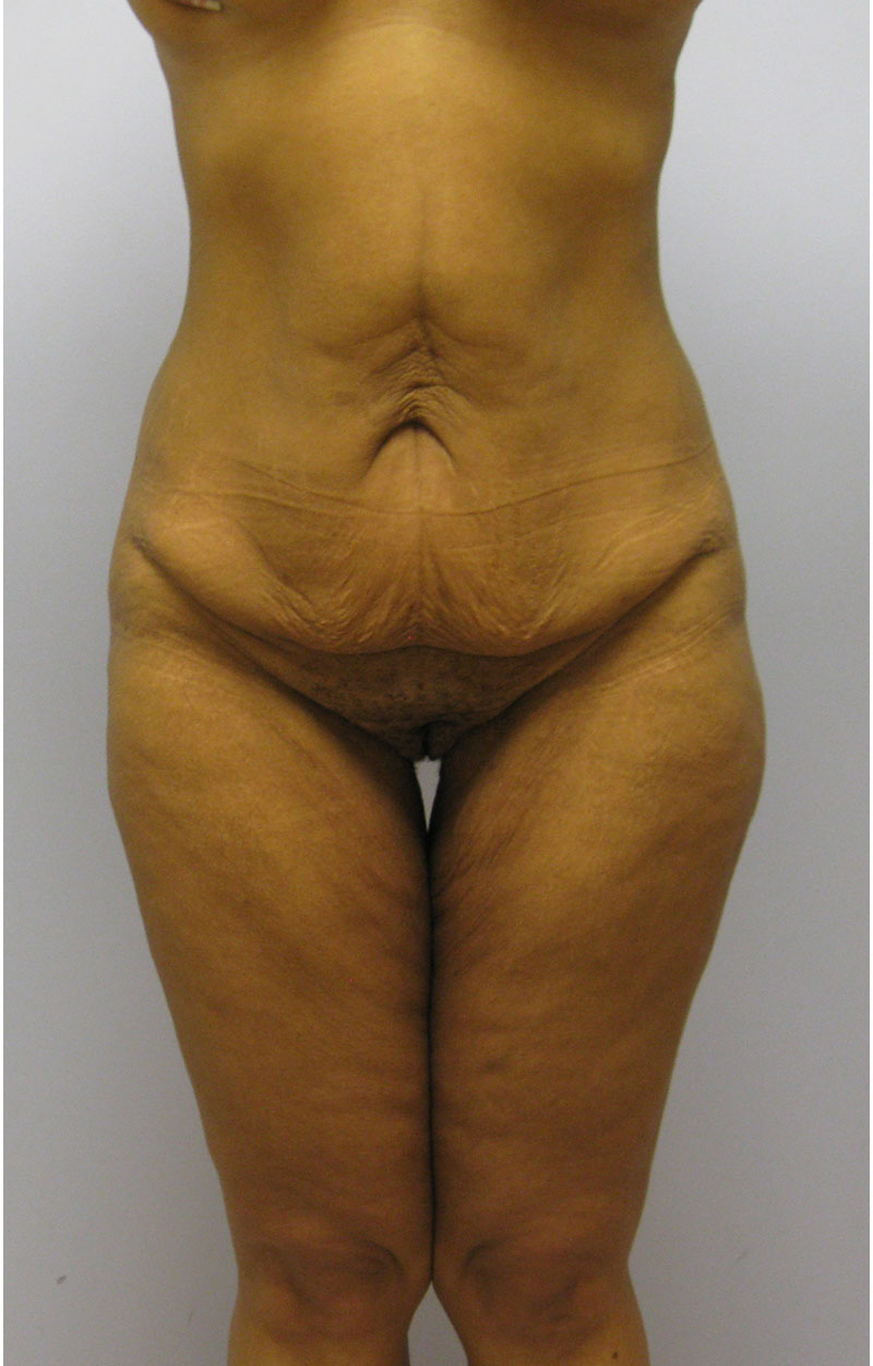 Body Lift Before & After Image