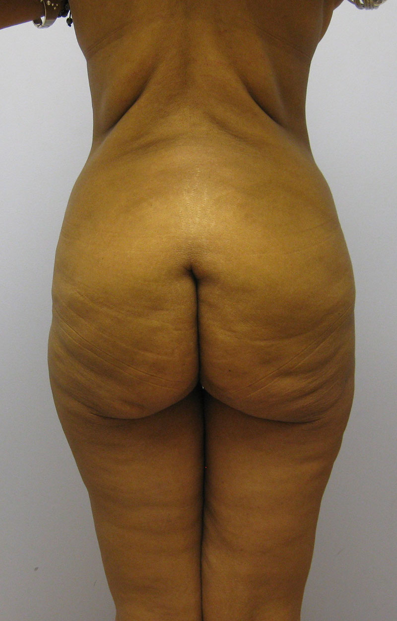 Body Lift Before & After Image