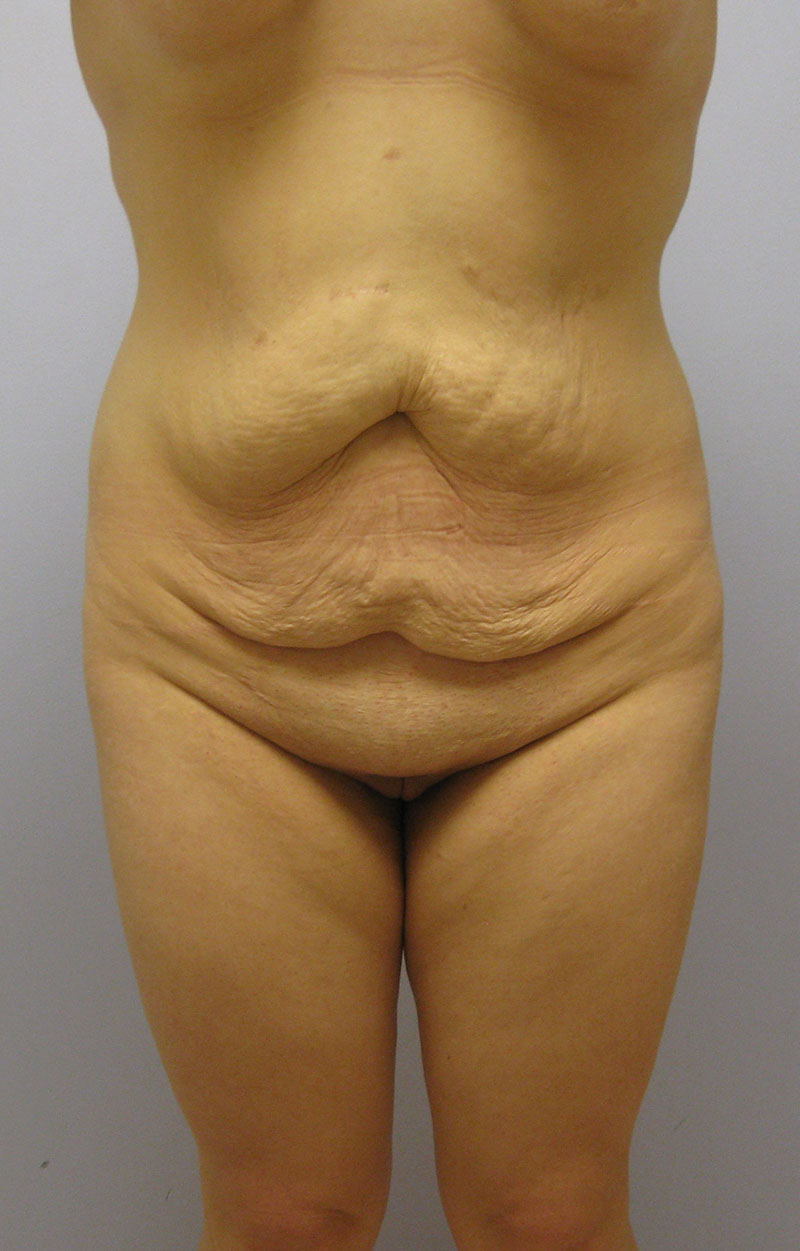 Body Lift Before & After Image