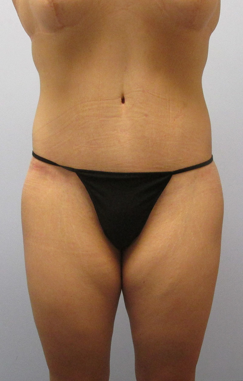 Body Lift Before & After Image