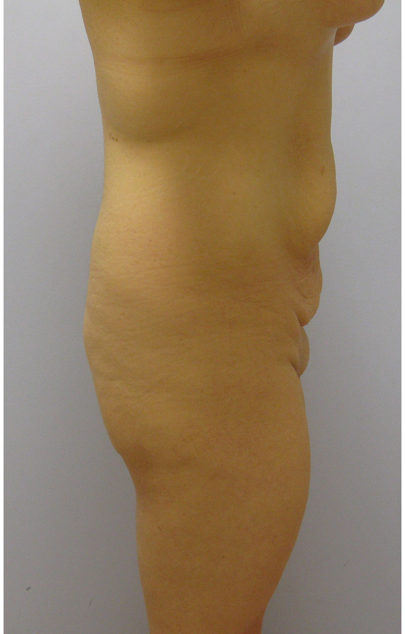 Body Lift Before & After Image