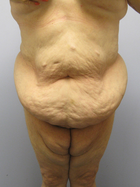 Body Lift Before & After Image