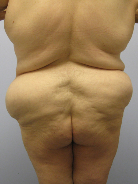 Body Lift Before & After Image