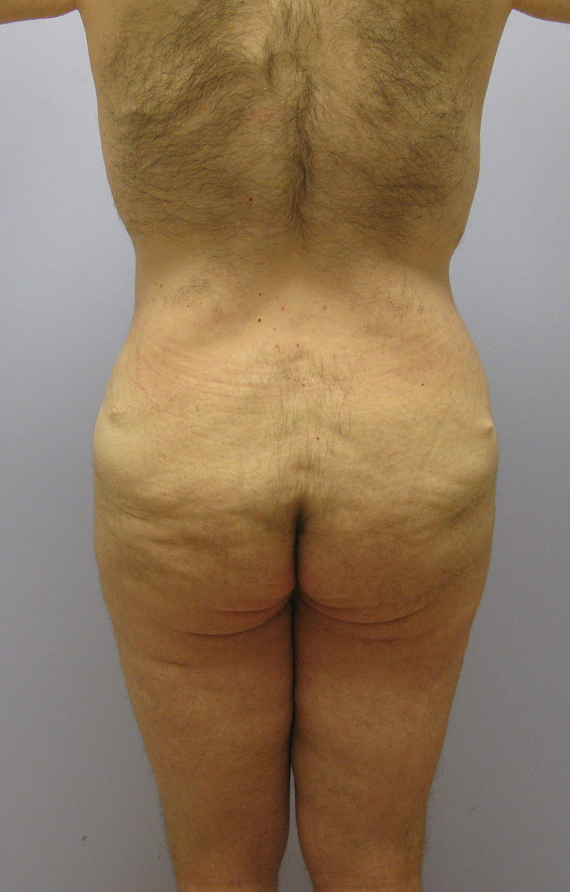 Body Lift Before & After Image