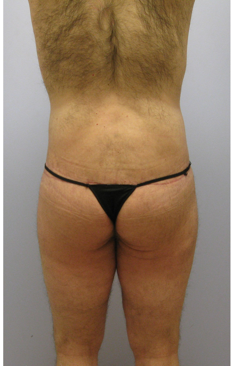 Body Lift Before & After Image