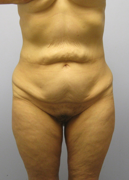 Body Lift Before & After Image