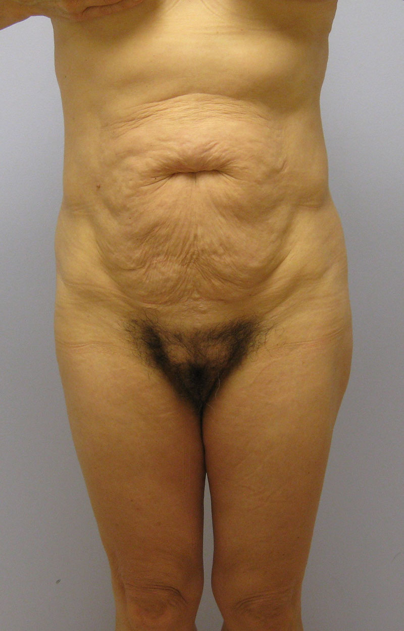 Body Lift Before & After Image