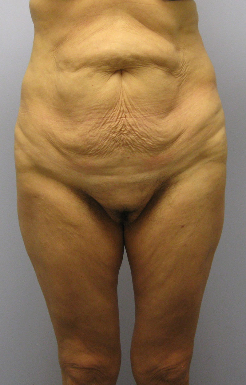 Body Lift Before & After Image