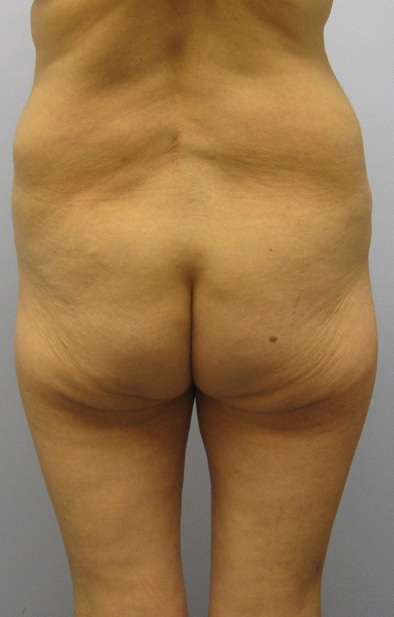 Body Lift Before & After Image