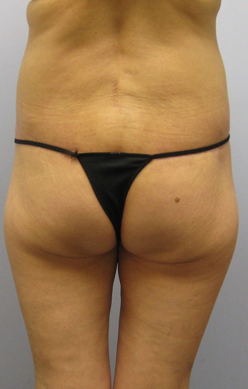 Body Lift Before & After Image