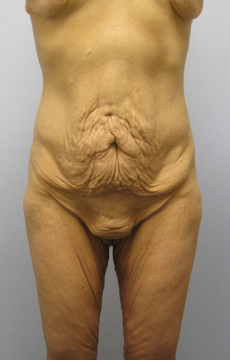 Body Lift Before & After Image