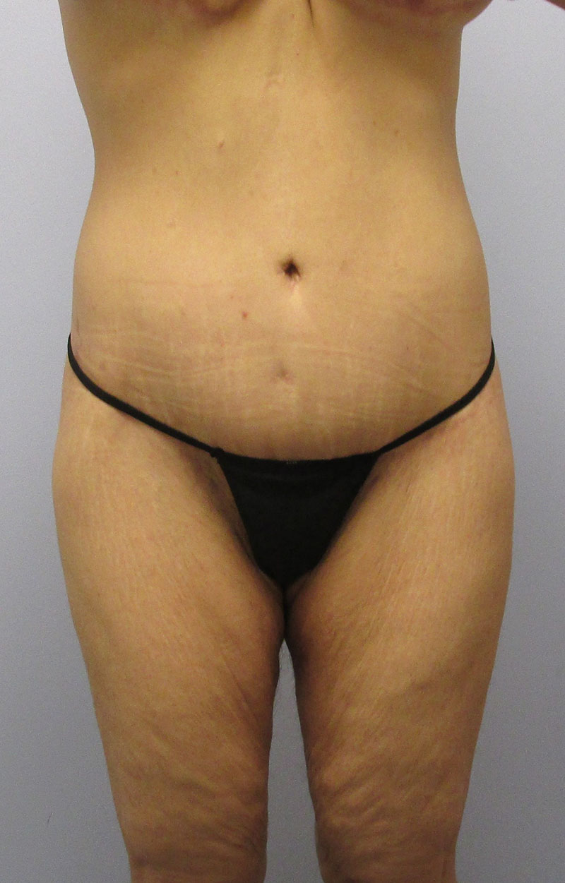 Body Lift Before & After Image