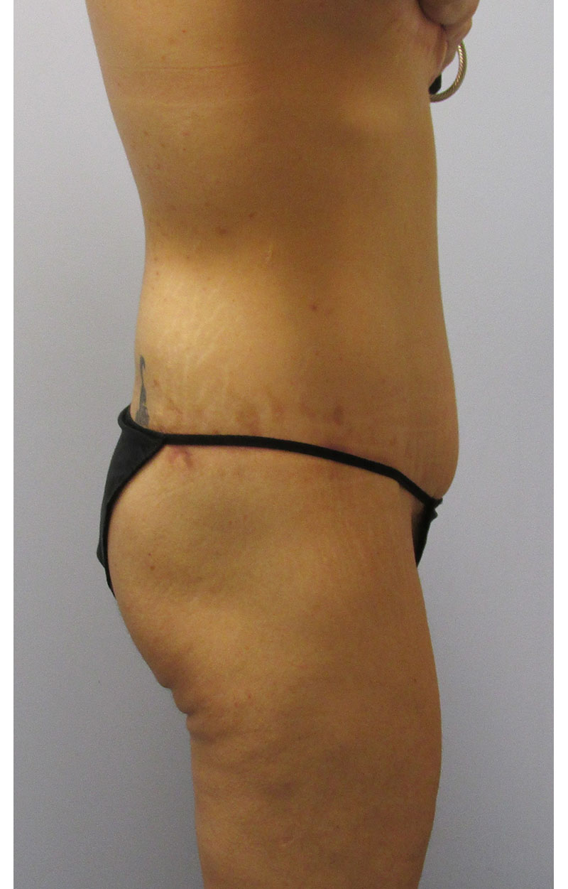 Body Lift Before & After Image