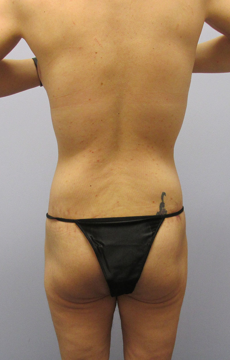 Body Lift Before & After Image