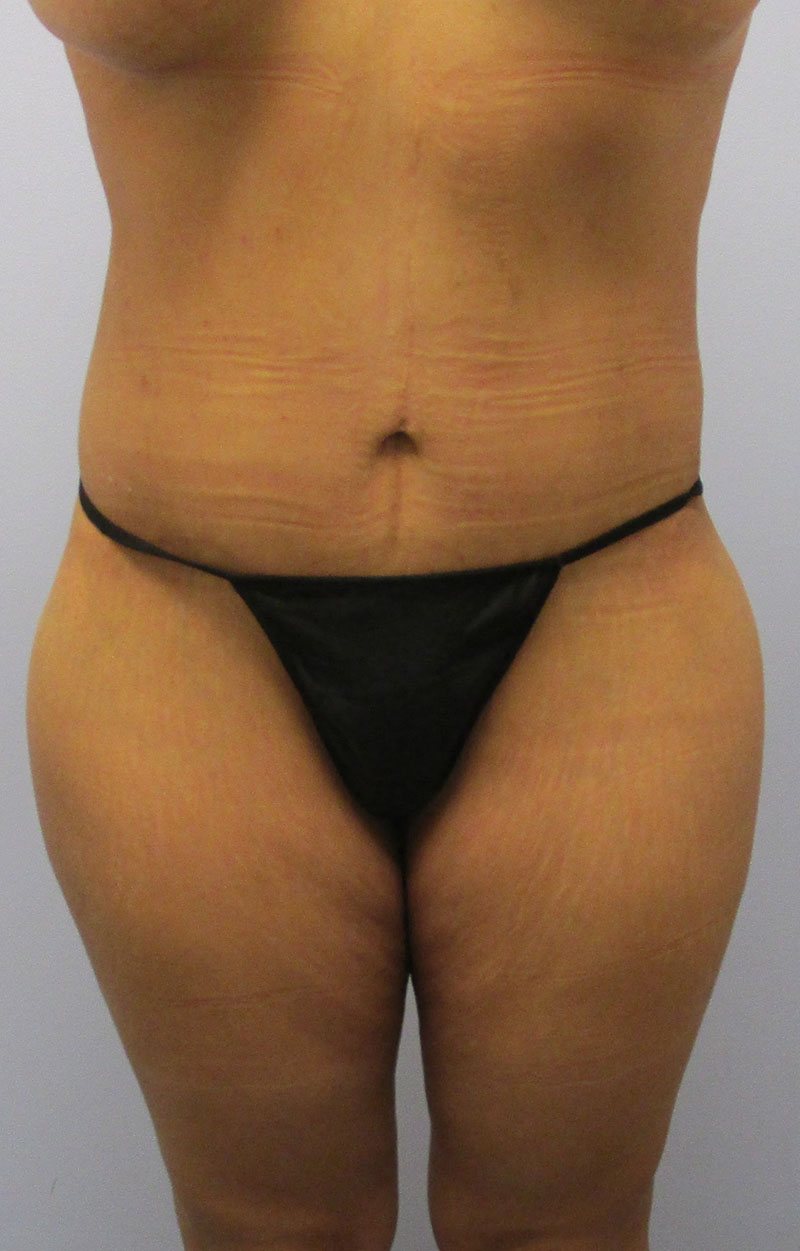 Body Lift Before & After Image