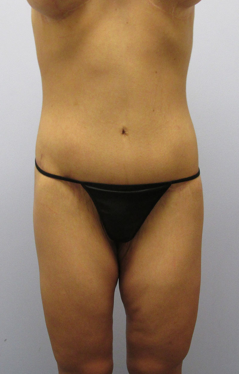 Body Lift Before & After Image