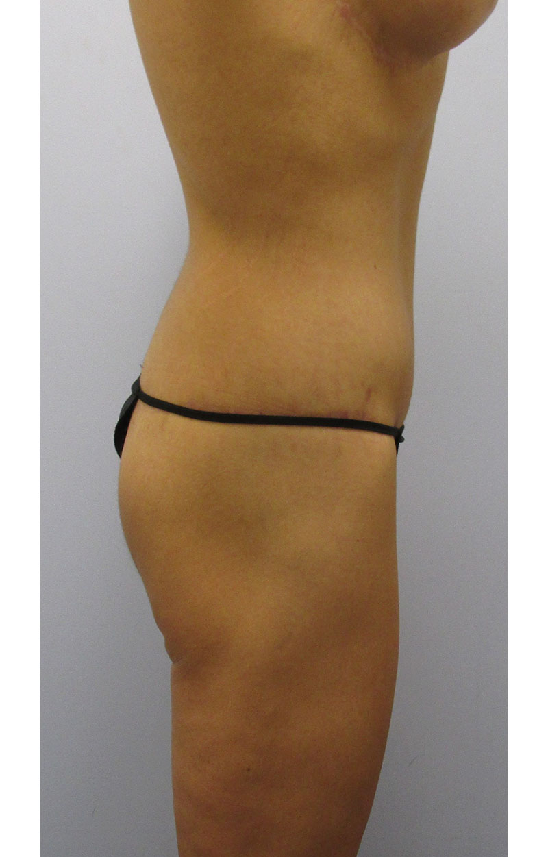 Body Lift Before & After Image