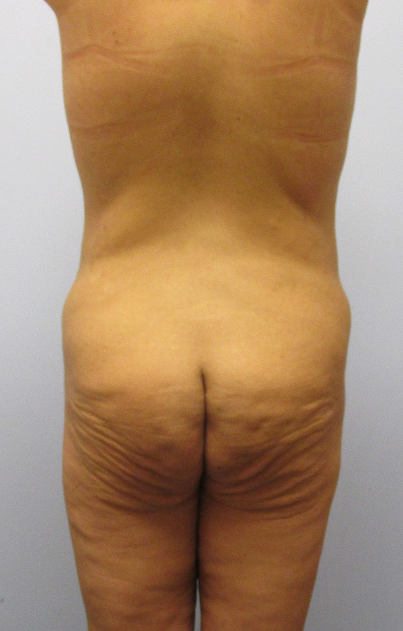 Body Lift Before & After Image