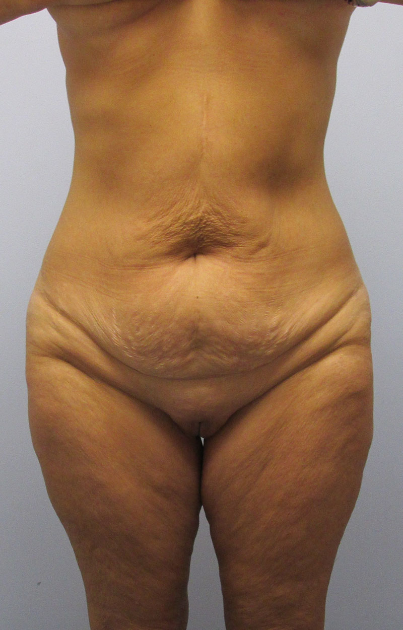 Body Lift Before & After Image