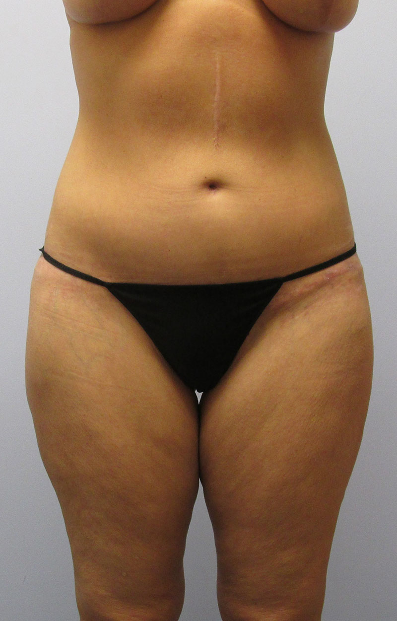 Body Lift Before & After Image