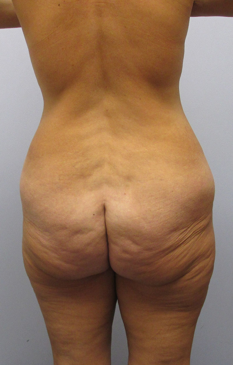 Body Lift Before & After Image