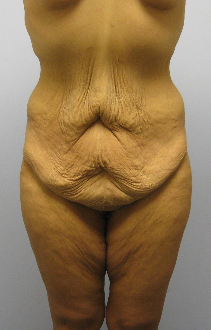 Body Lift Before & After Image