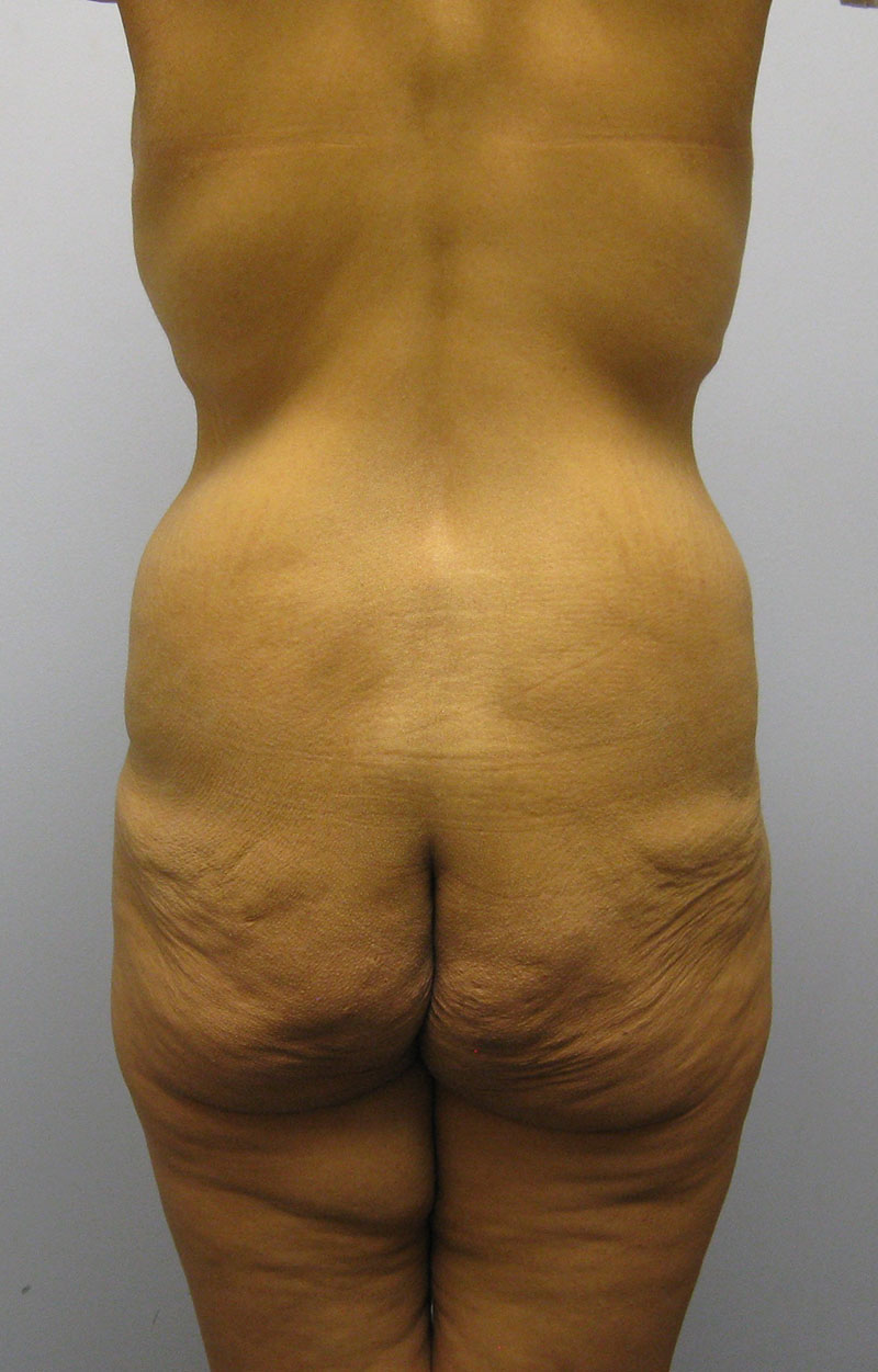 Body Lift Before & After Image