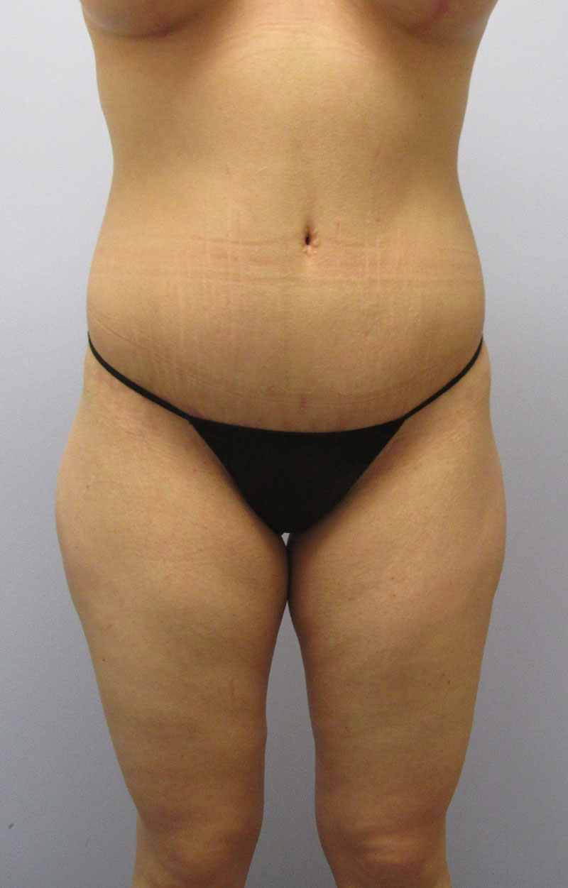 Body Lift Before & After Image