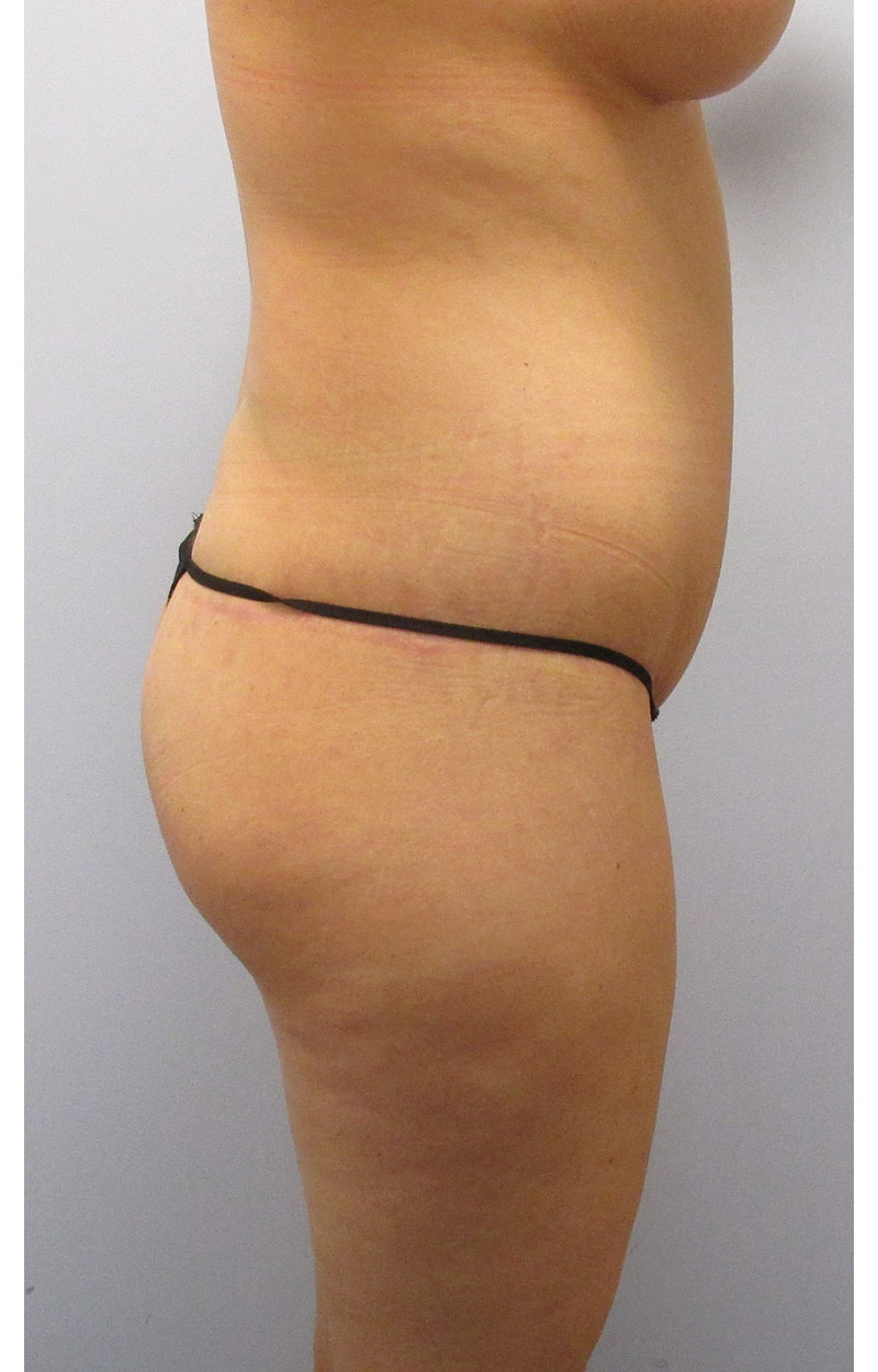 Body Lift Before & After Image