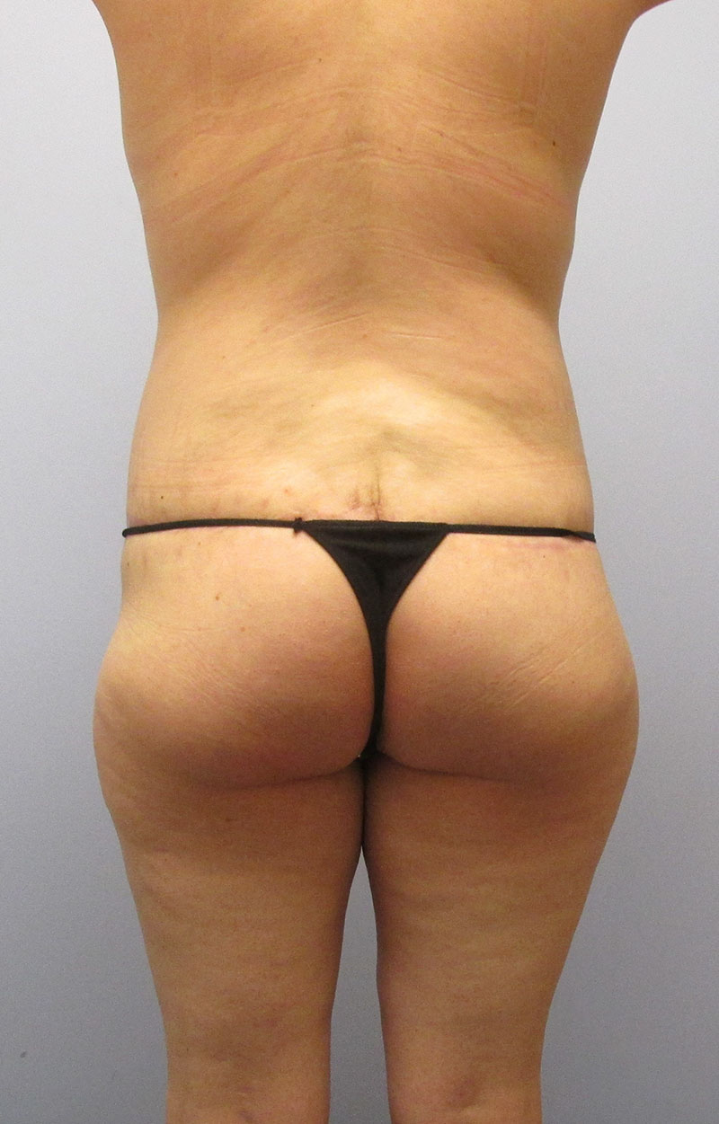 Body Lift Before & After Image