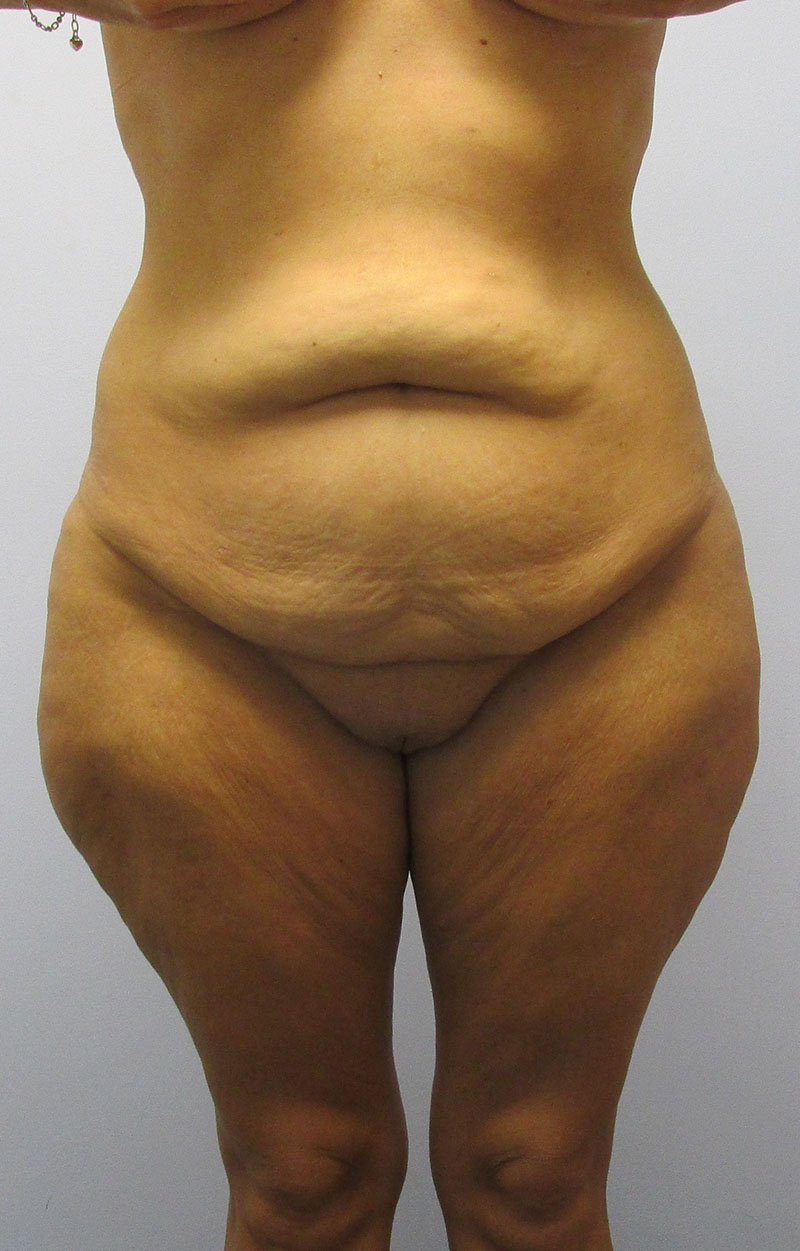 Body Lift Before & After Image