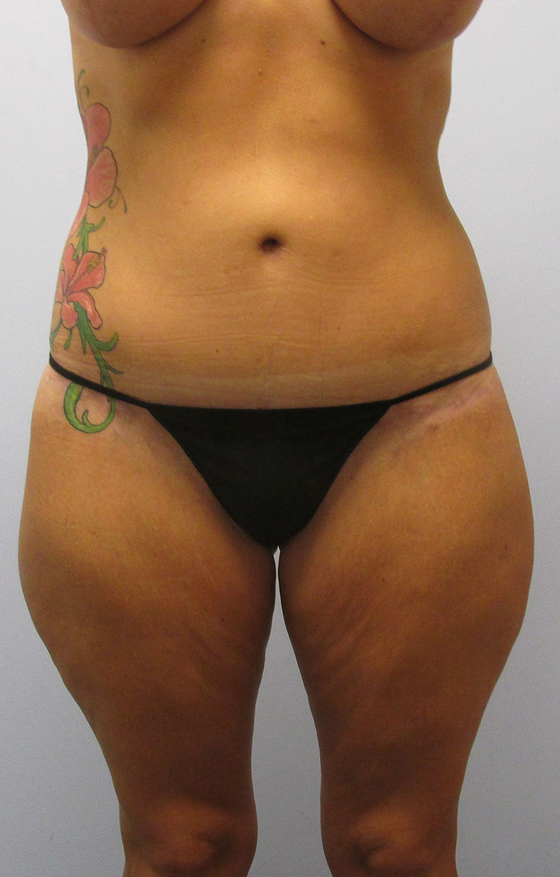 Body Lift Before & After Image