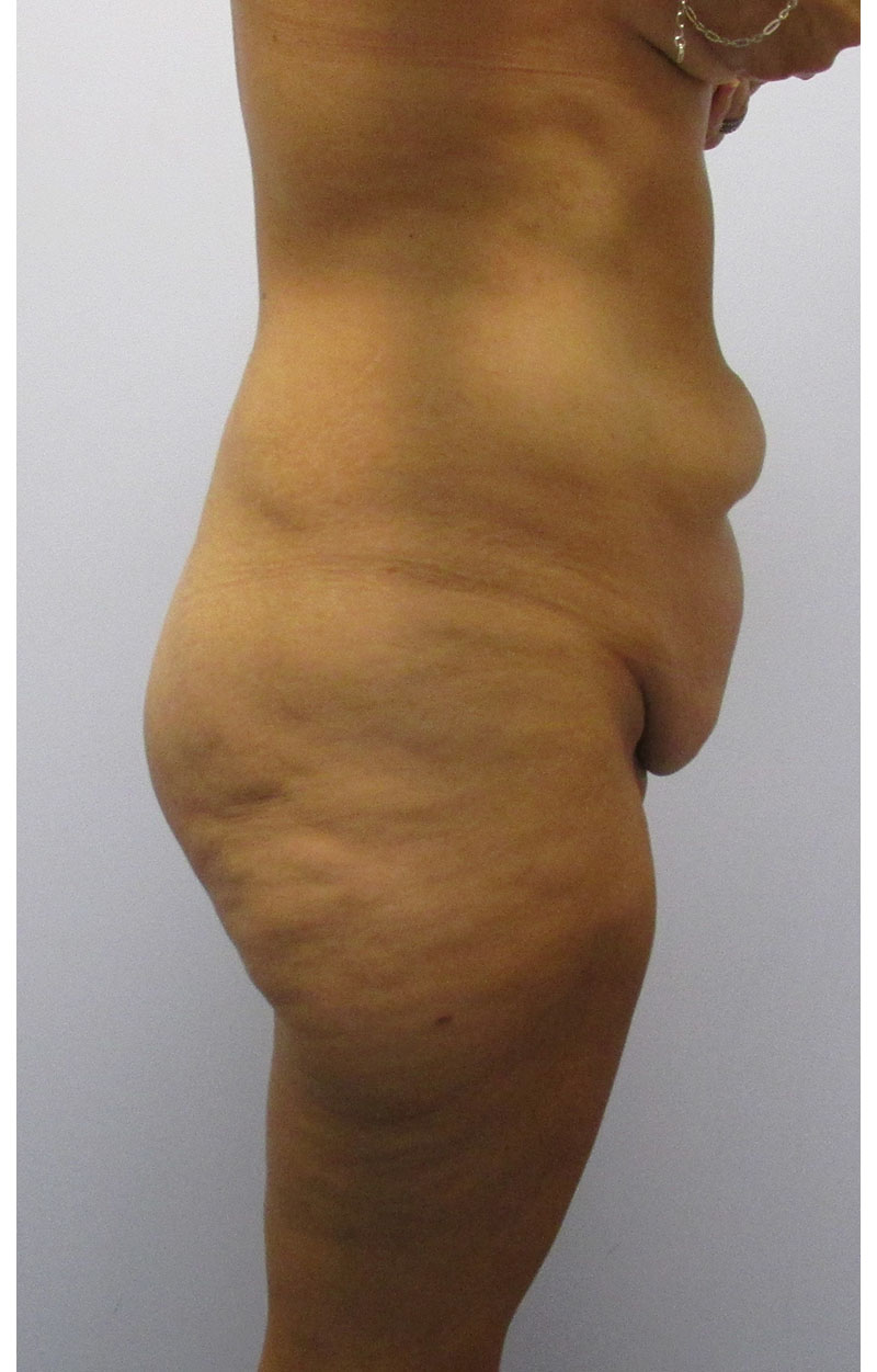 Body Lift Before & After Image