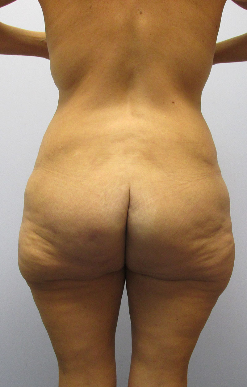 Body Lift Before & After Image