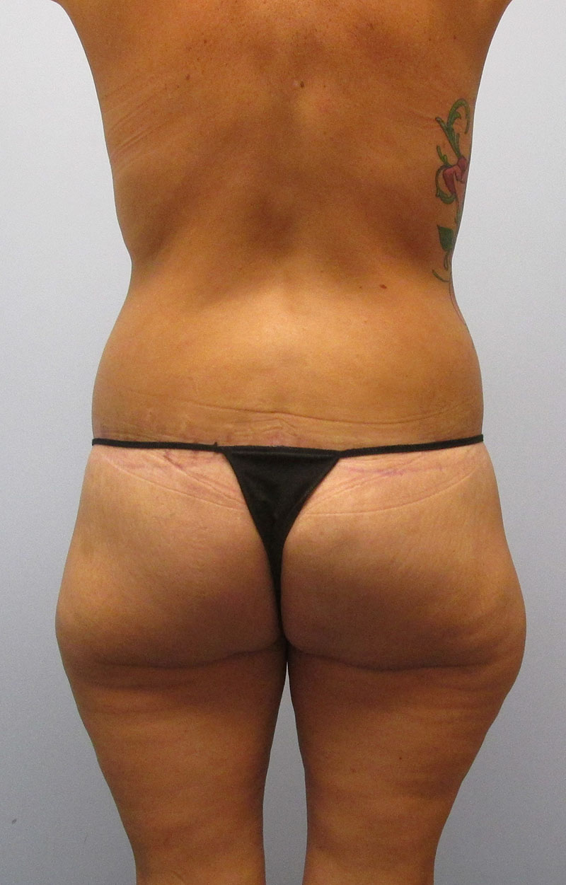 Body Lift Before & After Image