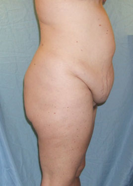 Body Lift Before & After Image