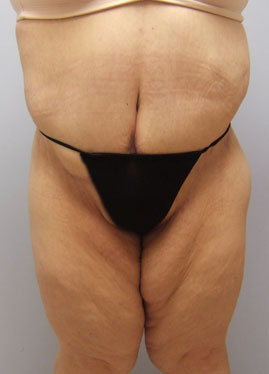 Body Lift Before & After Image